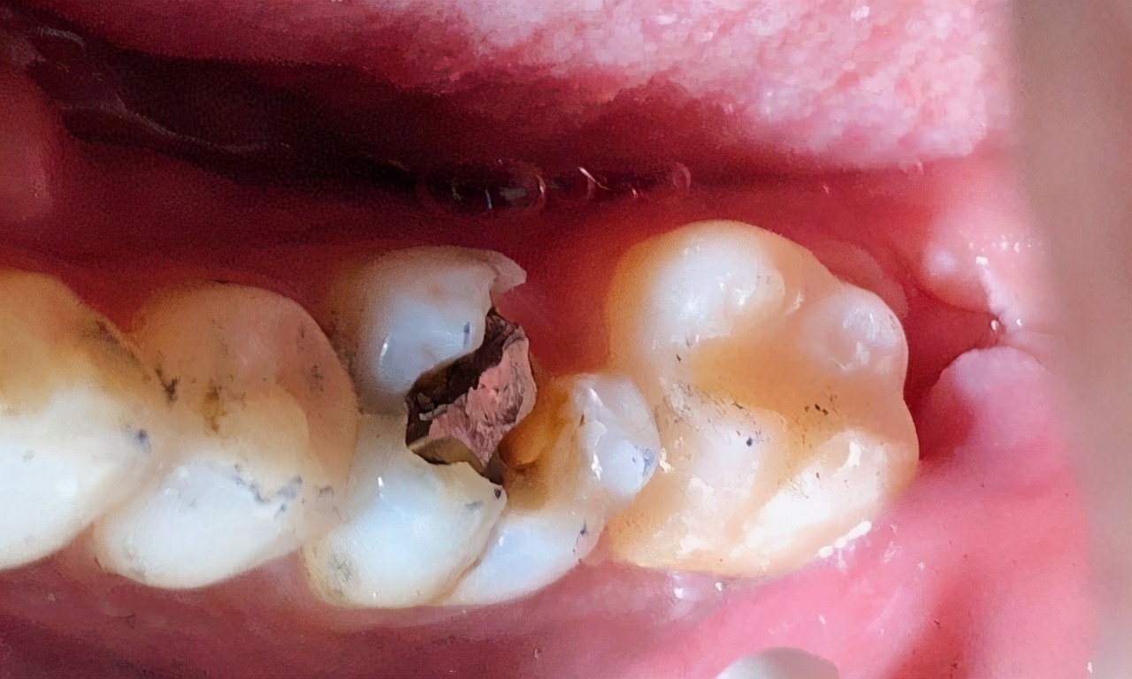 为什么补了牙齿反而牙齿痛,牙齿不痛牙龈疼痛为什么