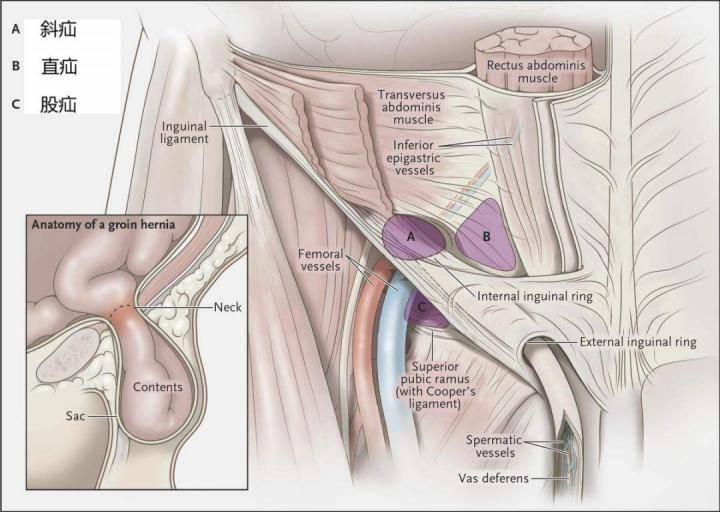 腹股沟中间那块肉是什么情况,腹股沟处在哪