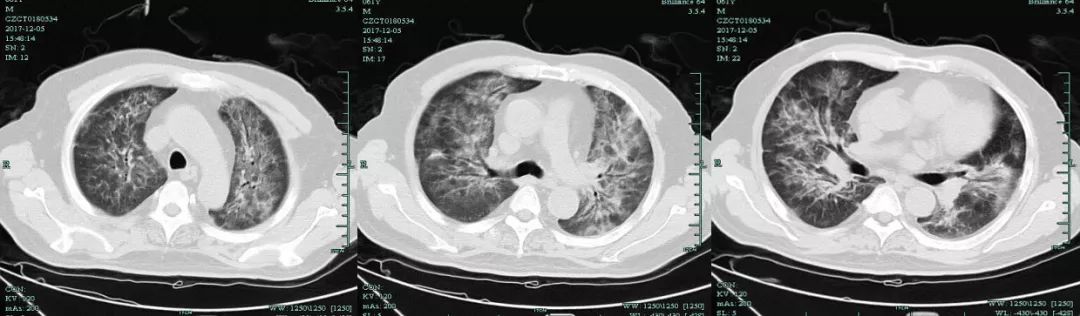 专家讲新冠二次感染的情况讲解,感染新冠专家怎么说