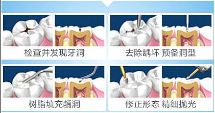 补牙是把牙洞都填平了吗,为啥补牙要把小洞变大