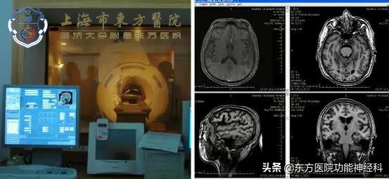 终生服用抗精神病药对身体的危害,正常人长期吃抗精神病药会怎样