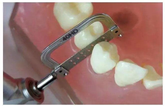 矫正拔牙全过程真实记录,拔牙后悔了不想矫正了怎么补救