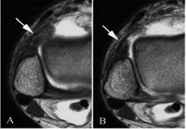 踝关节撞击症问诊,踝关节撞击综合征的x线表现