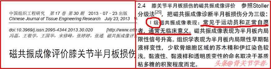磁共振图片讲解半月板损伤的程度,磁共振半月板损伤严重
