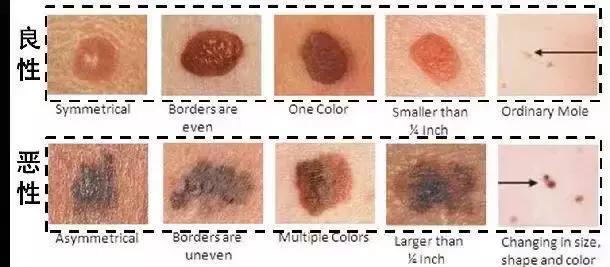 黑痣预防性去除有必要吗,原来去除黑痣是如此简单