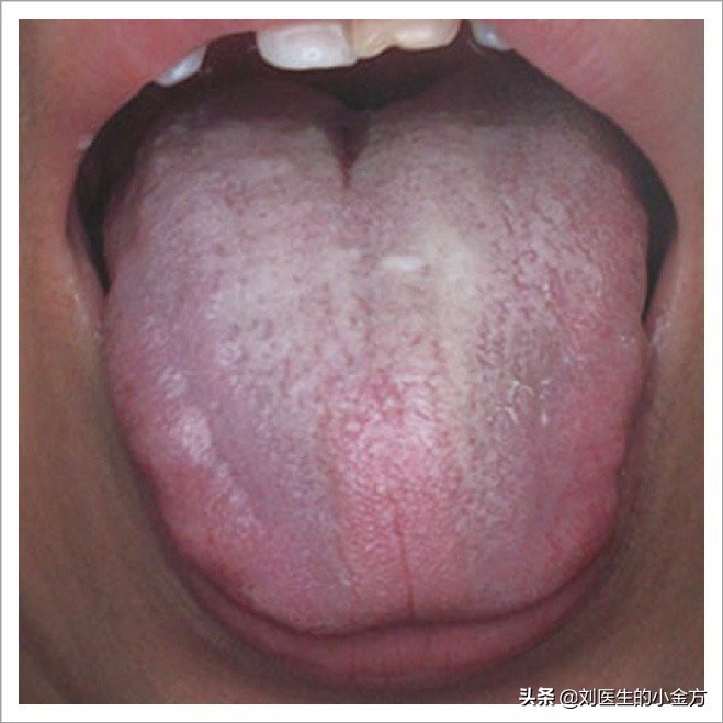 中医舌诊对照表100例,舌诊辨九大体质