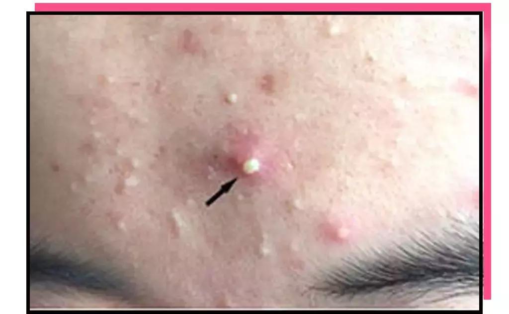 痘肌调理真实案例,痘肌10年了怎么修复