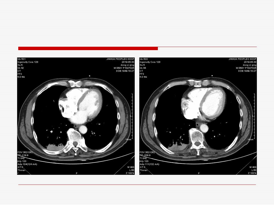 像炎症的肺癌能治好吗,医生说可能是肺癌也可能是炎症