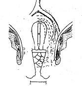 近距离放疗的副作用,近距离放疗