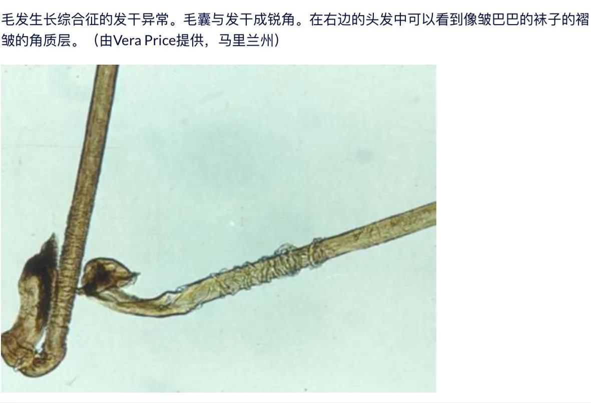 儿童脱发会是什么病的前兆,孩子毛囊引起的脱发怎么办