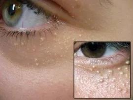 小孩眼睛旁边长脂肪粒是什么原因,眼睛周围长的脂肪粒怎么能消除