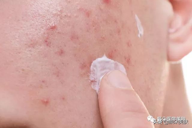 脸颊长痘痘是身体哪个部位出问题,脸上长痘痘是身体哪个部位的原因