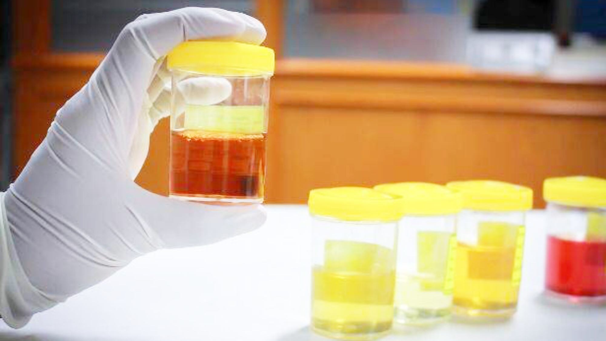 尿糖一般几个加号是糖尿病,尿糖跟糖尿病有什么区别