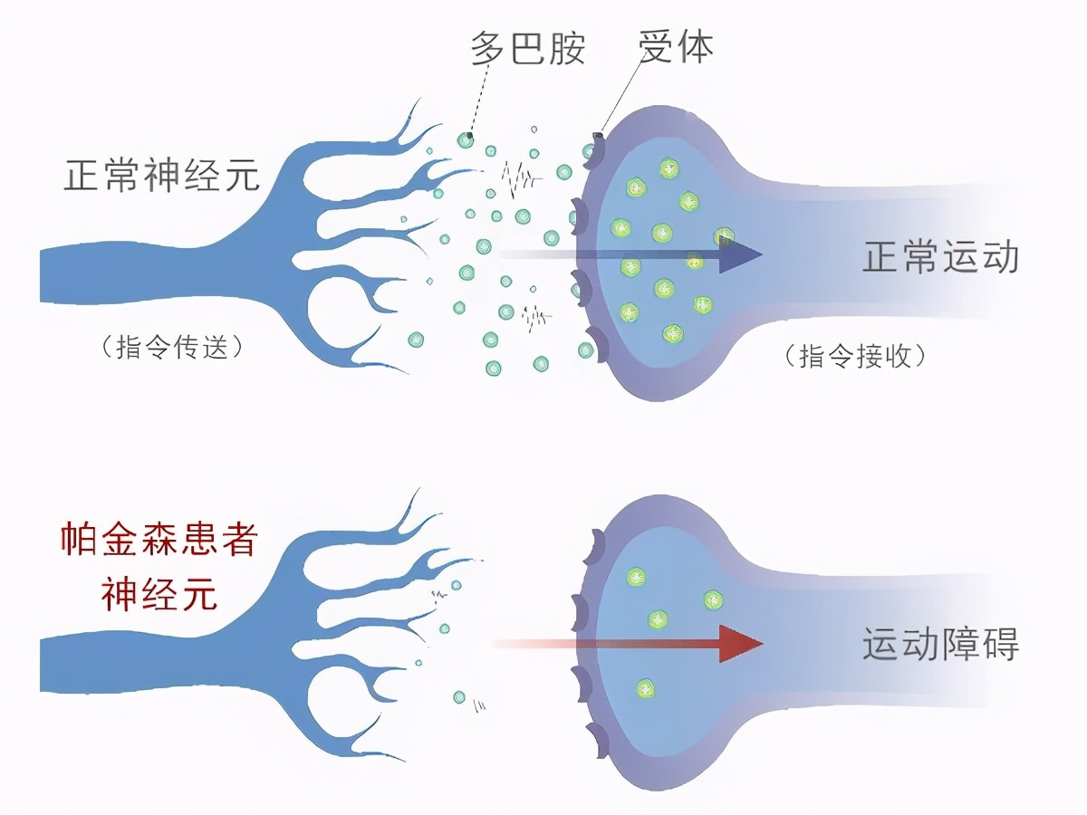 老年人手抖都是帕金森引起的吗,年轻人手抖记忆力差是不是帕金森