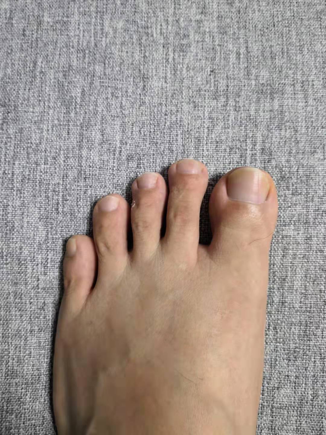 甲沟炎自愈的经历,甲沟炎的亲身经历