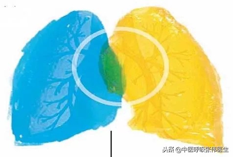 间质性肺疾病实例,特发性肺间质疾病的病理分型