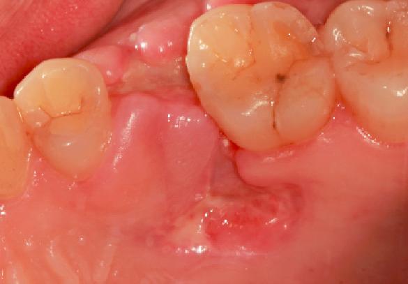 拔牙后的血洞是什么样的,拔牙后血窟窿恢复视频