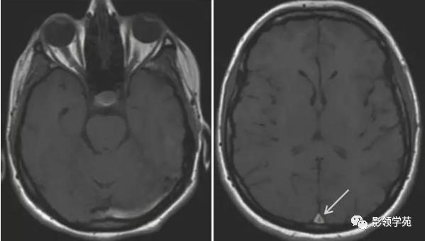 头部t1wi信号不均匀增高,脑t1wi和t2wi稍低信号