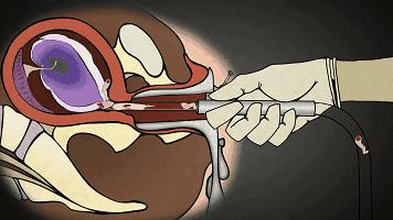 25岁的女生有几次打胎,女子堕胎6次连医生都惊讶了