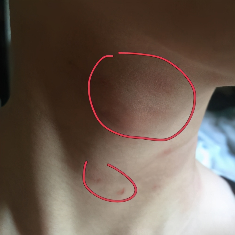 10个月白色糠疹的症状和治疗,圈状糠疹