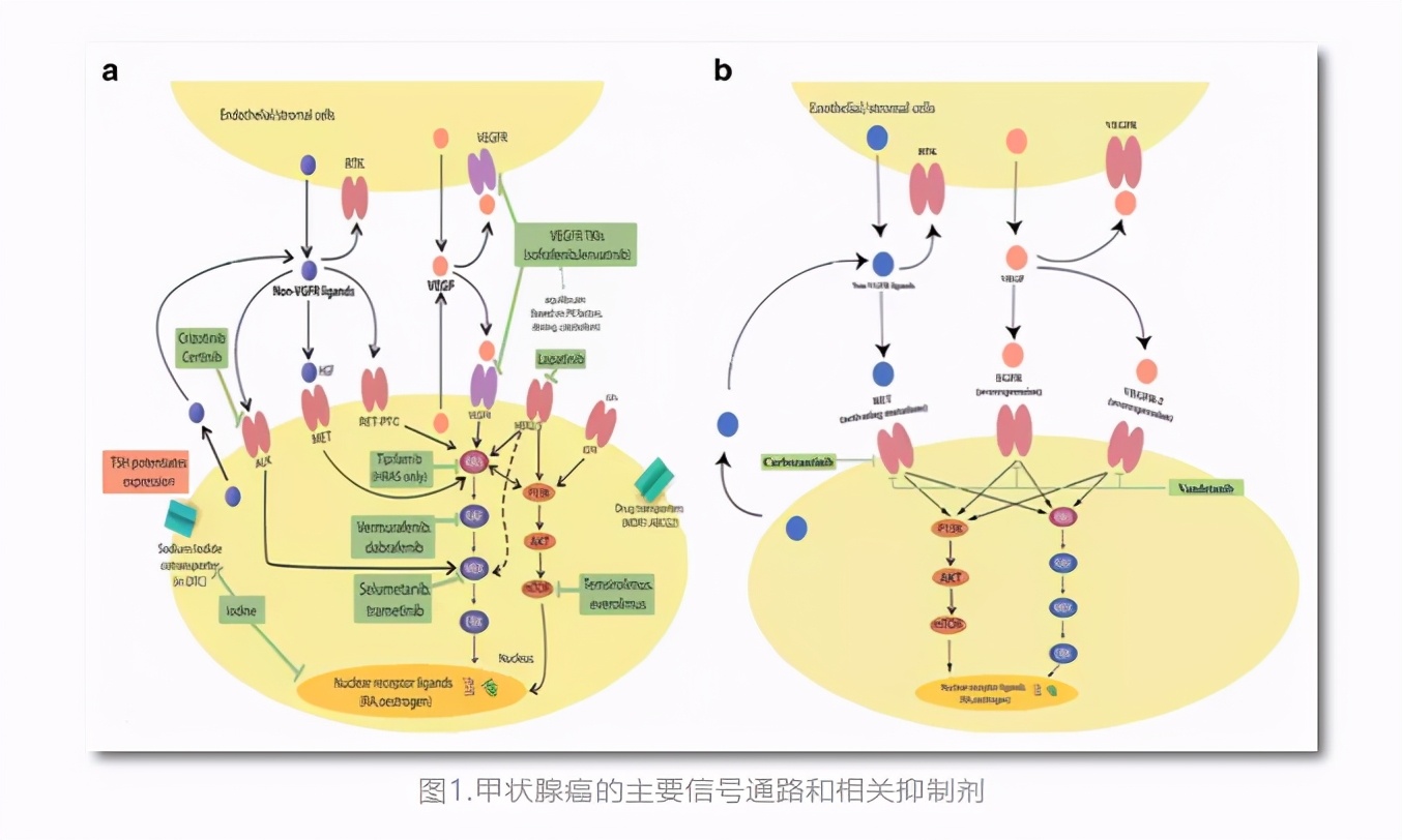 甲状腺癌晚期淋巴转移,甲状腺癌晚期全身酸痛