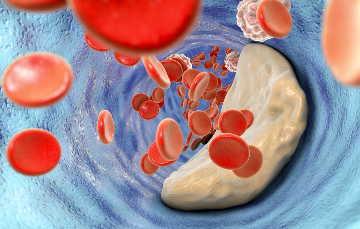 冠心病血管堵塞90%是什么症状,高龄老人心血管堵塞是什么症状