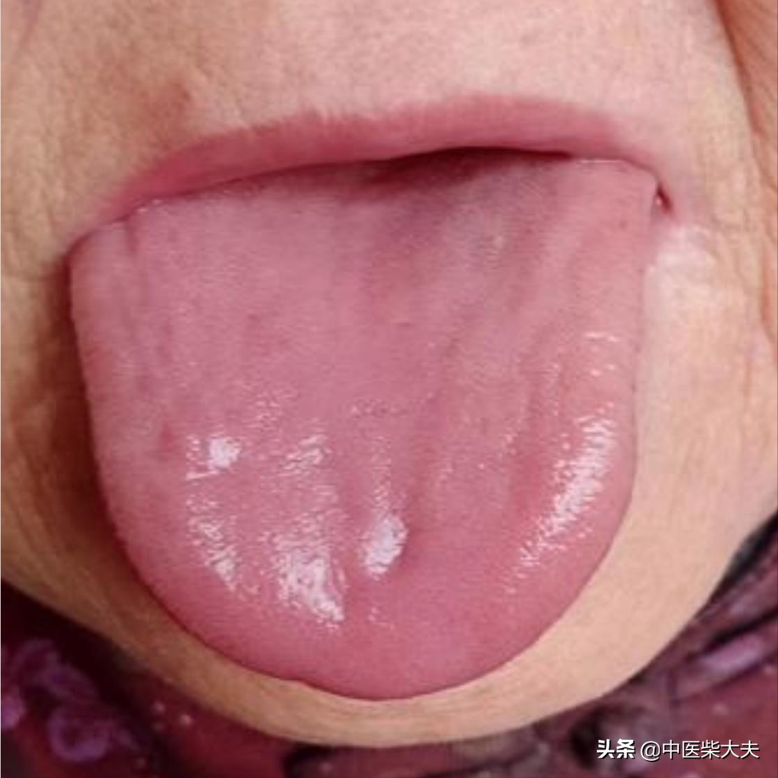 气阴两虚症状舌苔脉象,气阴两虚的症状中药方