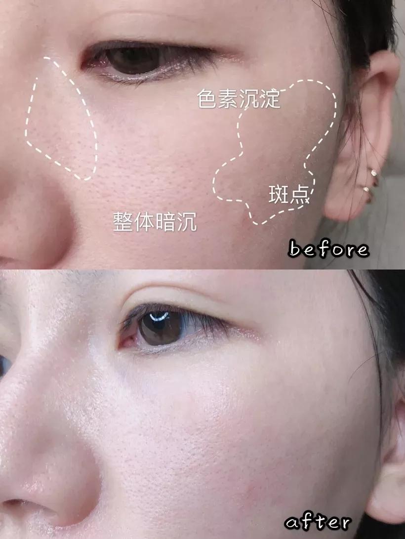 祛痘淡斑美白神器,2毛钱淡斑