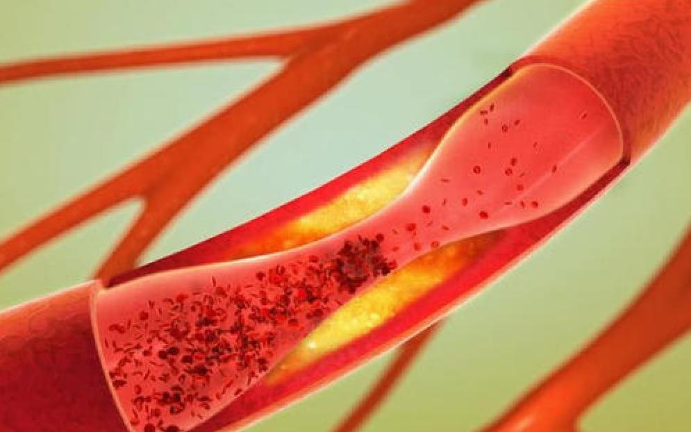 抽筋是缺钙的原因吗,抽筋真的是因为缺钙吗一图读懂