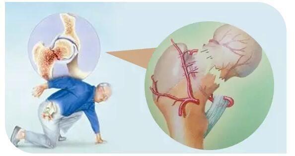 意外骨折是疾病吗,意外摔倒骨折的危害