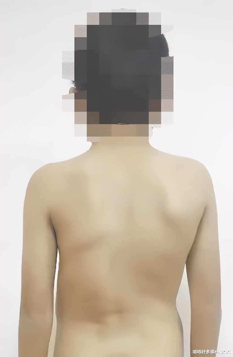 儿童颈椎侧弯会有什么后果,13岁孩子颈椎侧弯矫正睡姿图片