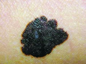 去除黑毛痣最有效方法,黑毛痣去除有几种办法