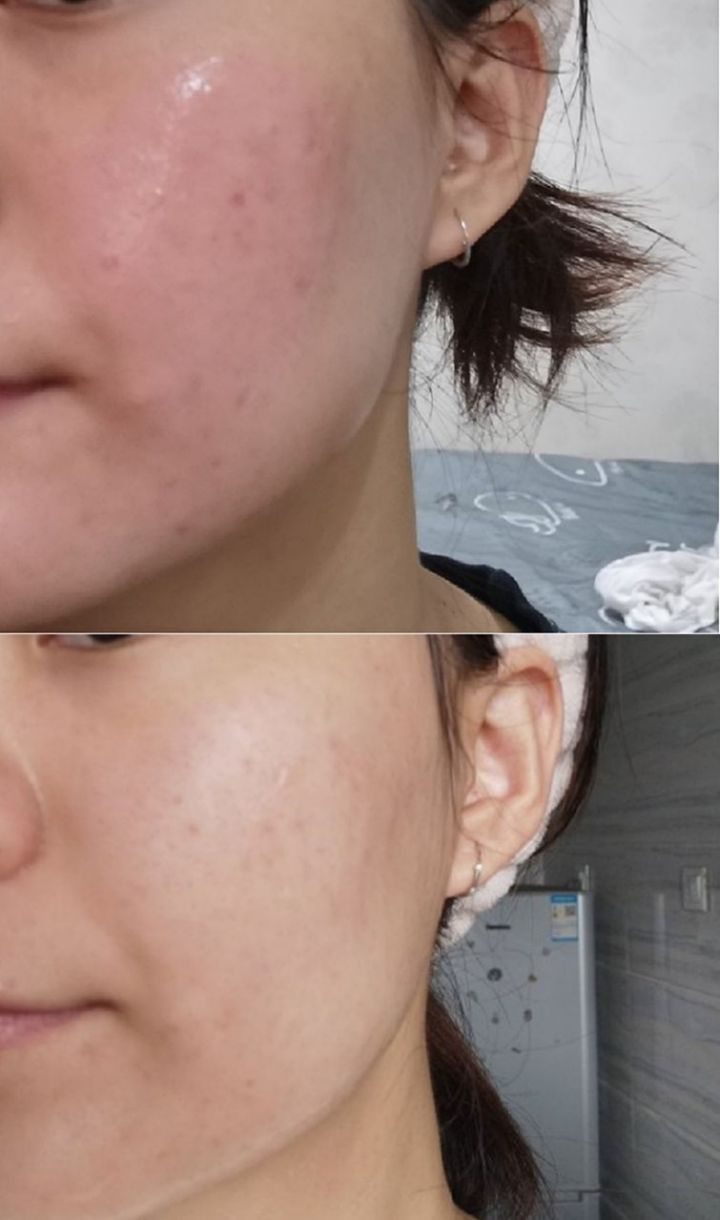 博乐达水杨酸面膜怎么辨别真假,博乐达水杨酸面膜抹上特别粘