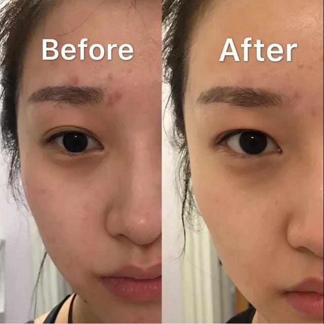 痘肌用什么祛痘膏最好,痘友分享心酸的祛痘之路