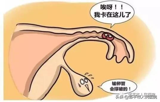 异位妊娠是不是输卵管出现问题,输卵管异位妊娠科普