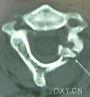 所有骨折都叫什么名字,骨折的名称有哪些