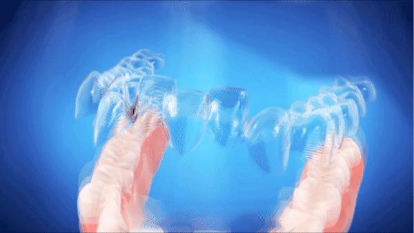 钢牙和隐形牙套怎么选择,钢牙和半隐形牙套有什么区别