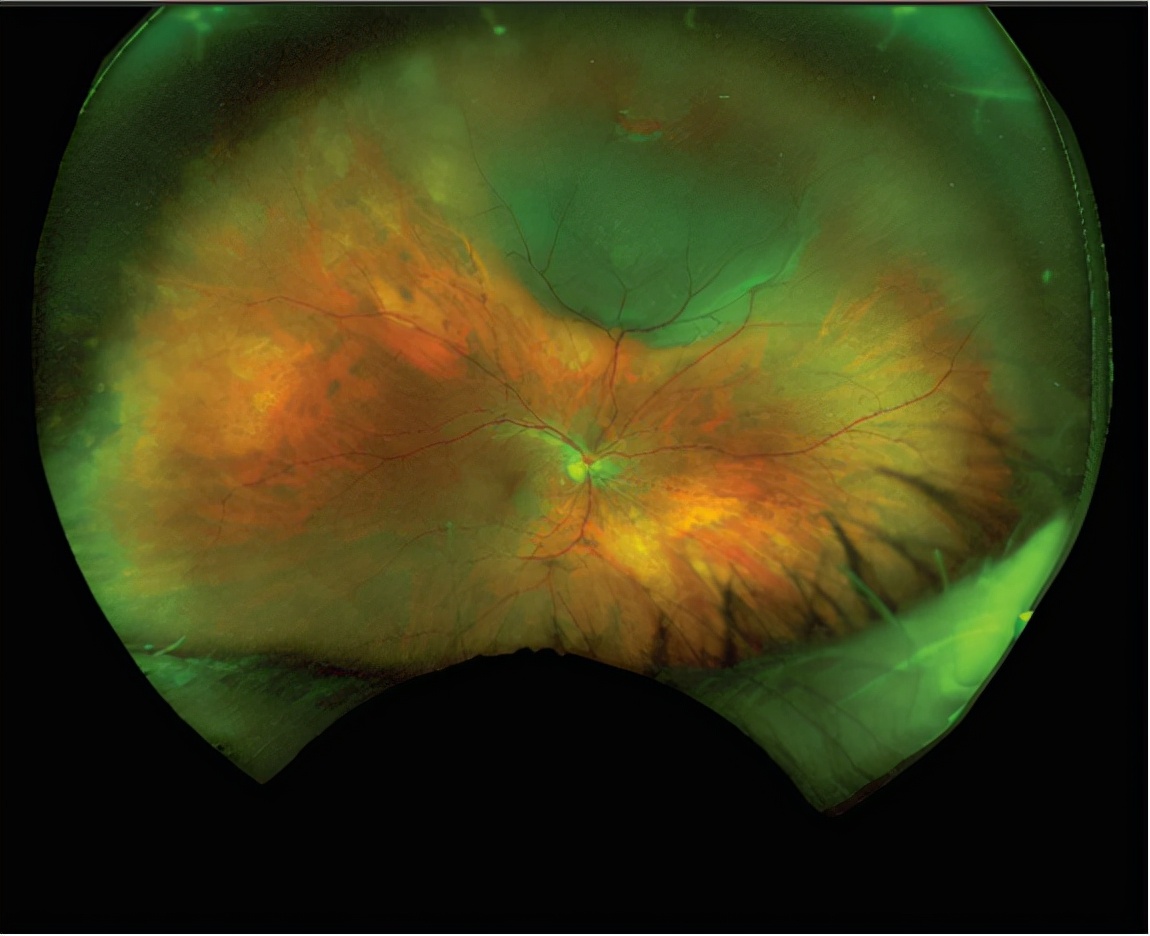 对眼药水过敏怎么办,对眼药水过敏怎么解决