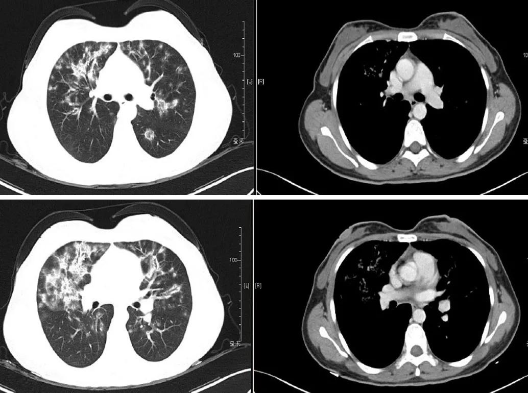 机化性肺炎必须病理确诊吗,机化性肺炎好转的征兆