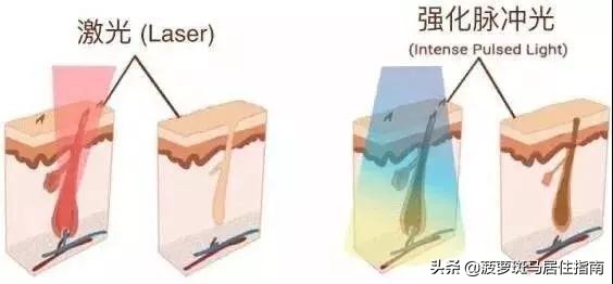 最简单的脱毛大法,推荐5个脱毛方法