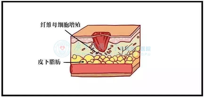 为什么伤好了会留疤,为什么一个小伤口愈合后都会留疤