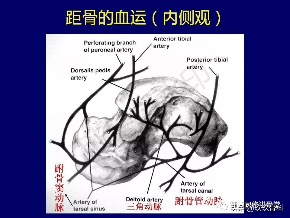 距骨骨折后遗症,距骨骨折怎么办