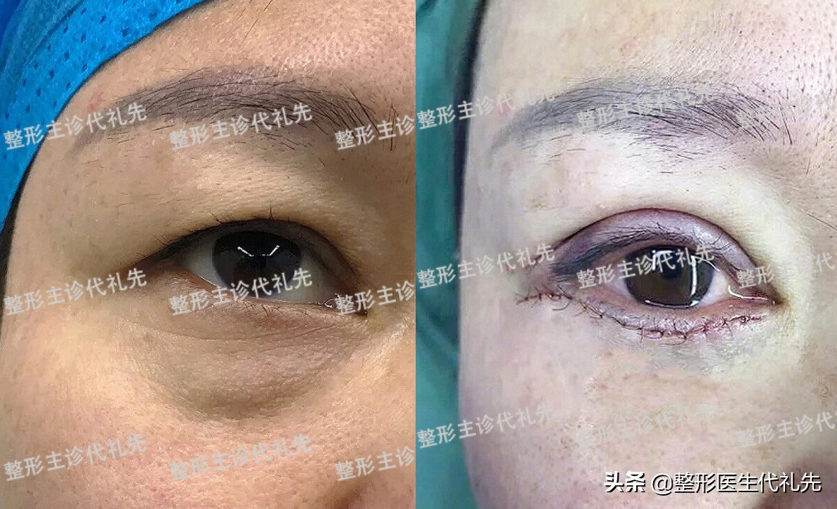 眼袋泪沟填充用什么方法最好,泪沟填充多了像眼袋怎么办