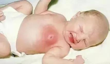 还在给新生儿挤乳头？这种糟糕习俗危害大到抱憾终身