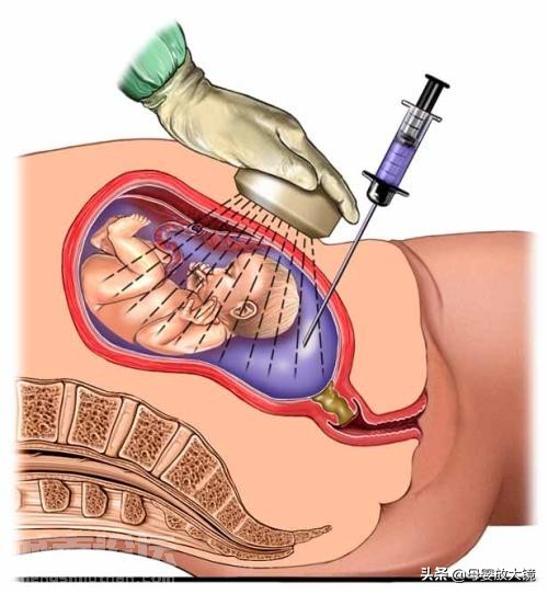 孕期产检:B超,唐筛,羊水穿刺,彩超...什么时间最合适?注意