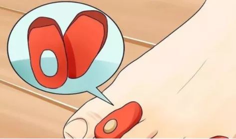 如何预防与处理比跑步膝痛还烦人的水泡？