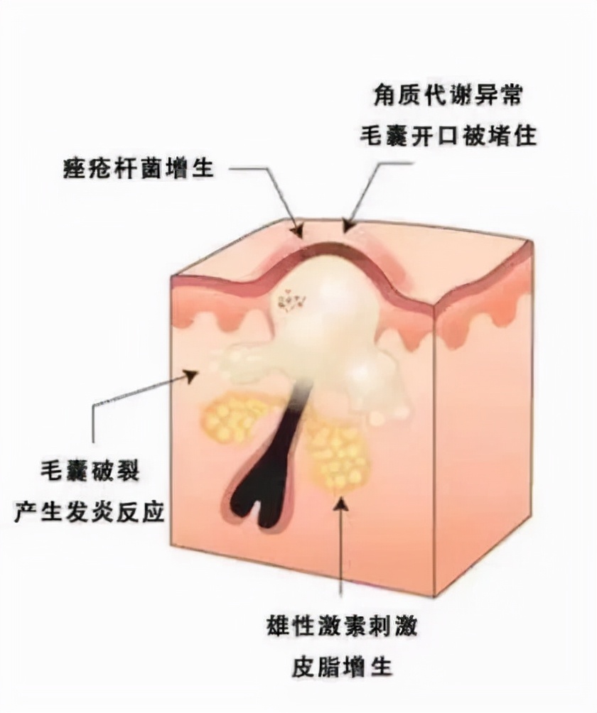 丘疹性痤疮是什么,30岁丘疹性痤疮