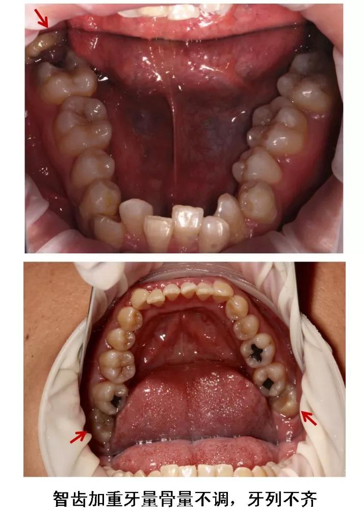 Helen齿科中心——智齿是不是非拔不可？