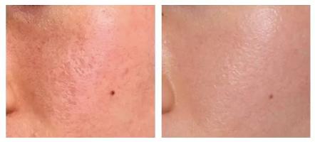 让无数姑娘无从下手的痘印，皮肤科医生有了解决新招