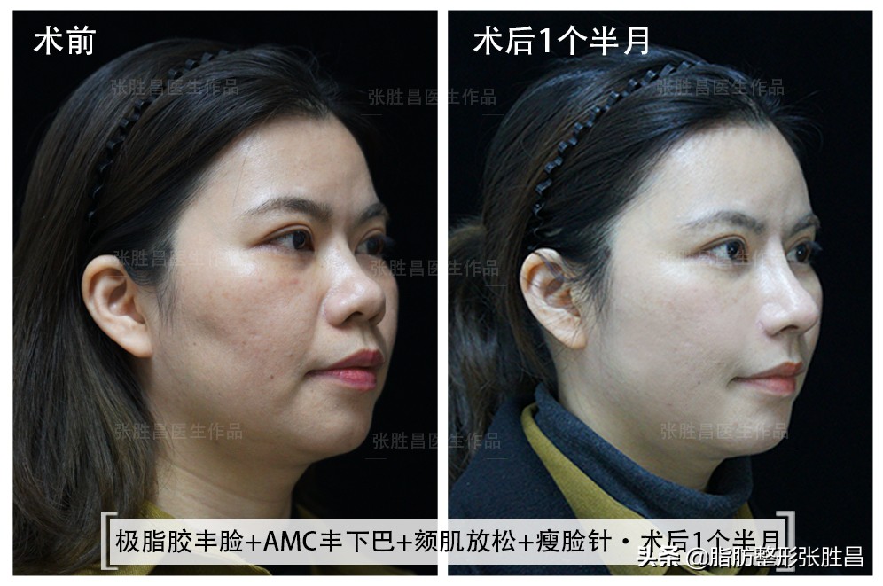 爱笑的女孩笑起来法令纹很明显,笑的时候有法令纹的人怎么样